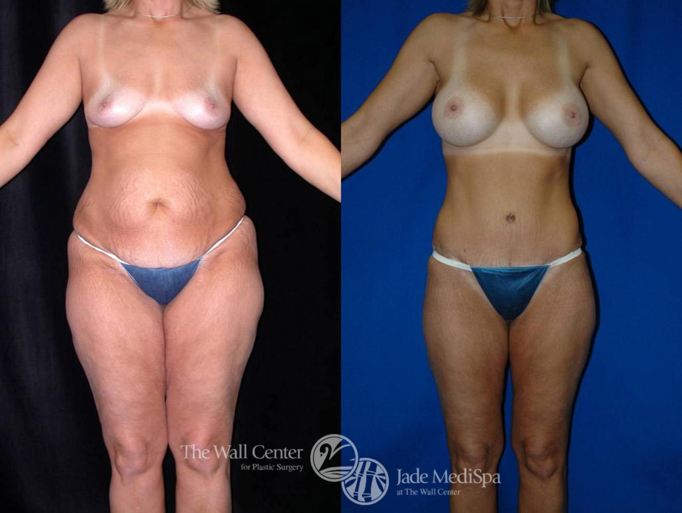 Tummy Tuck Case 21 Before & After View #1 | Shreveport, LA | The Wall Center