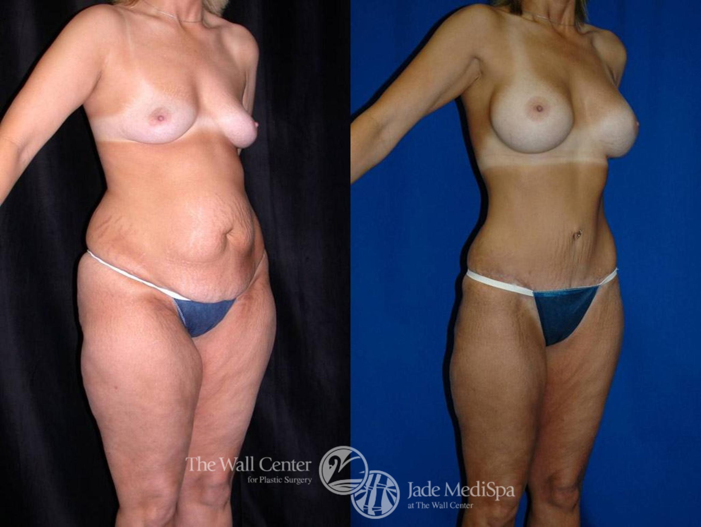 Before & After Tummy Tuck Case 21 View #2 View in Shreveport, LA