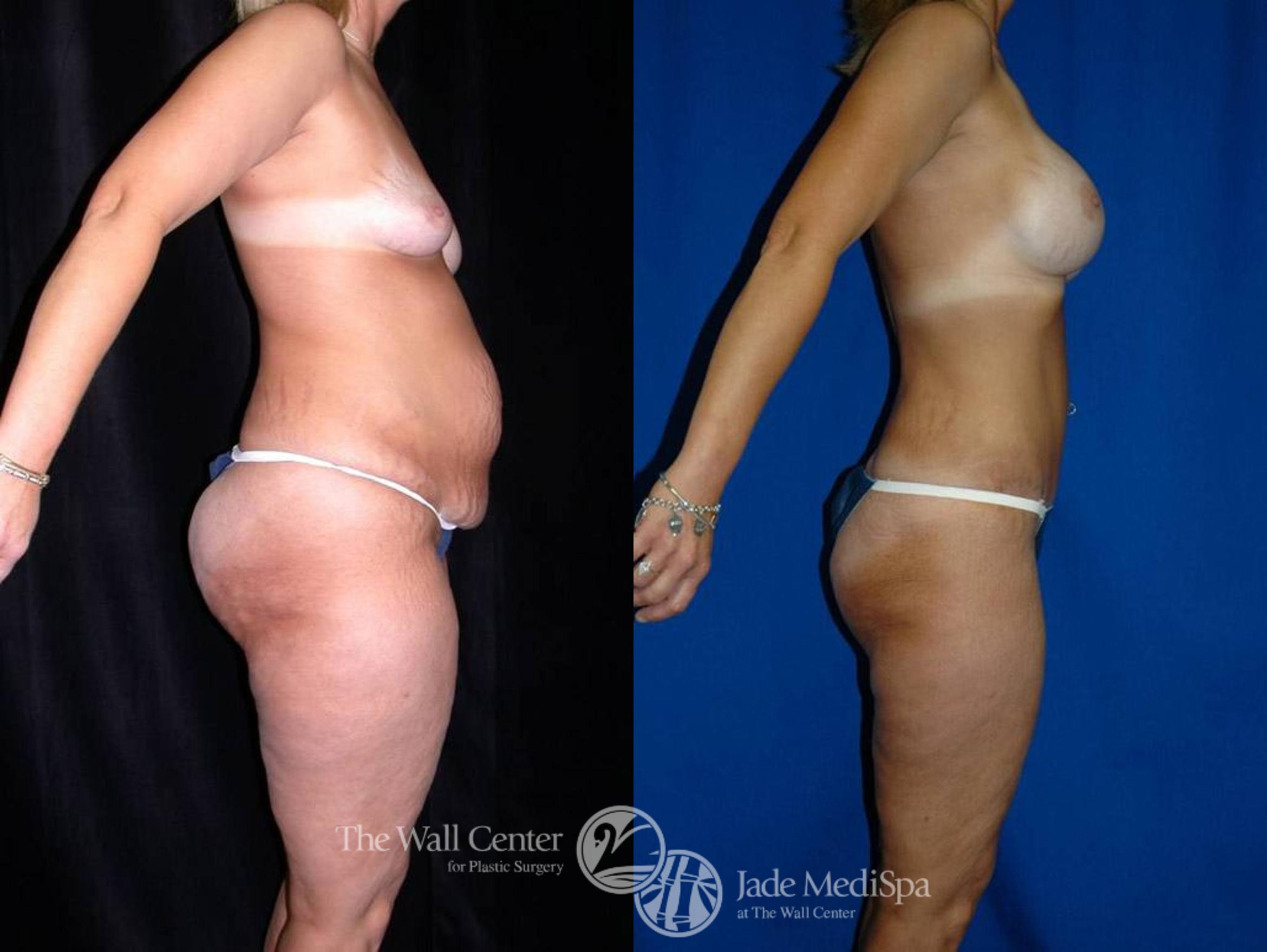 Before & After SAFELipo™ Case 21 View #3 View in Shreveport, LA