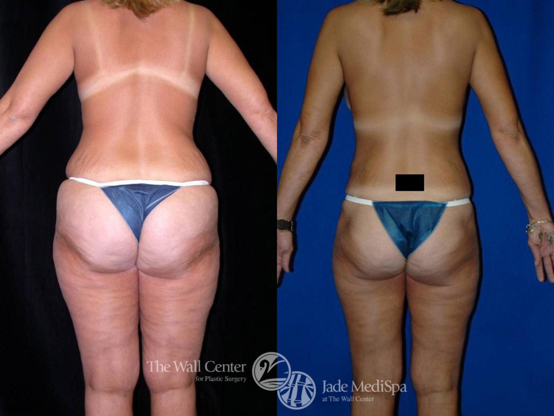 Before & After Tummy Tuck Case 21 View #4 View in Shreveport, LA