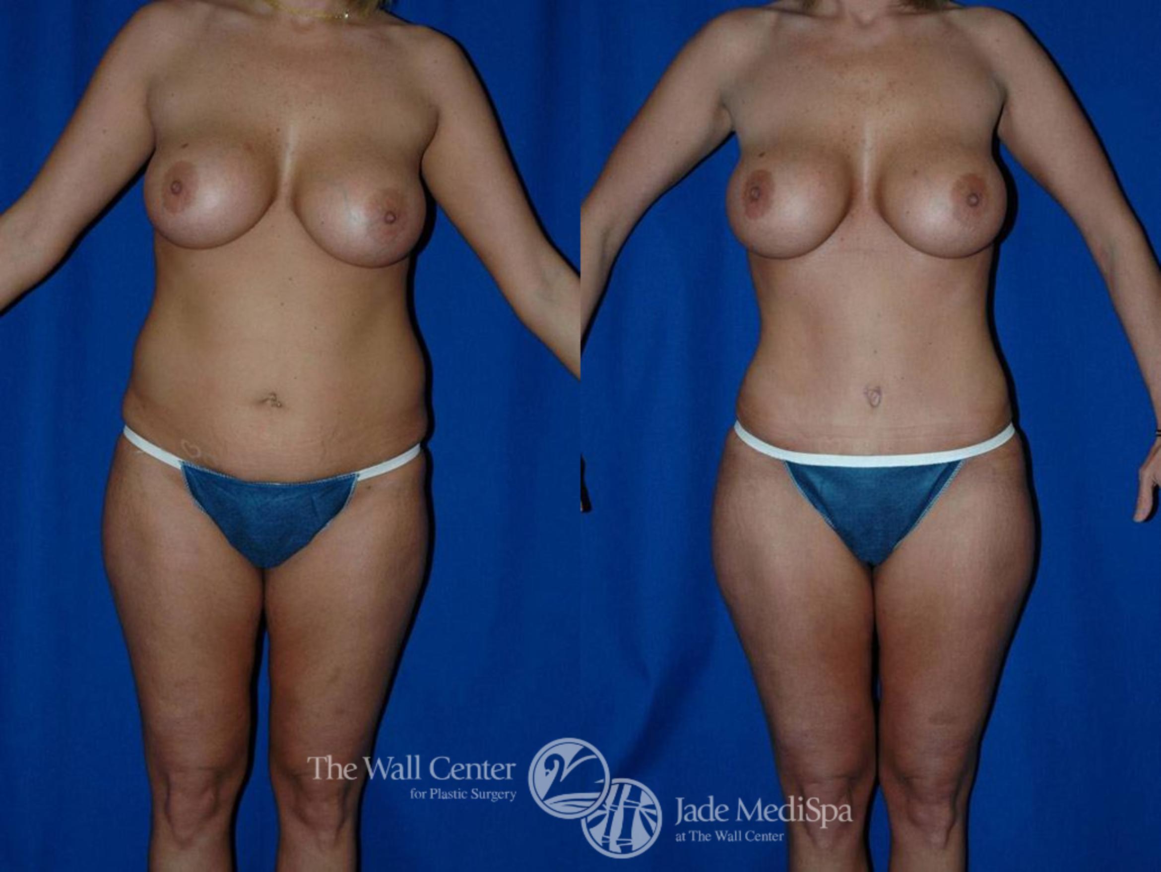 Before & After Tummy Tuck Case 23 View #2 View in Shreveport, LA
