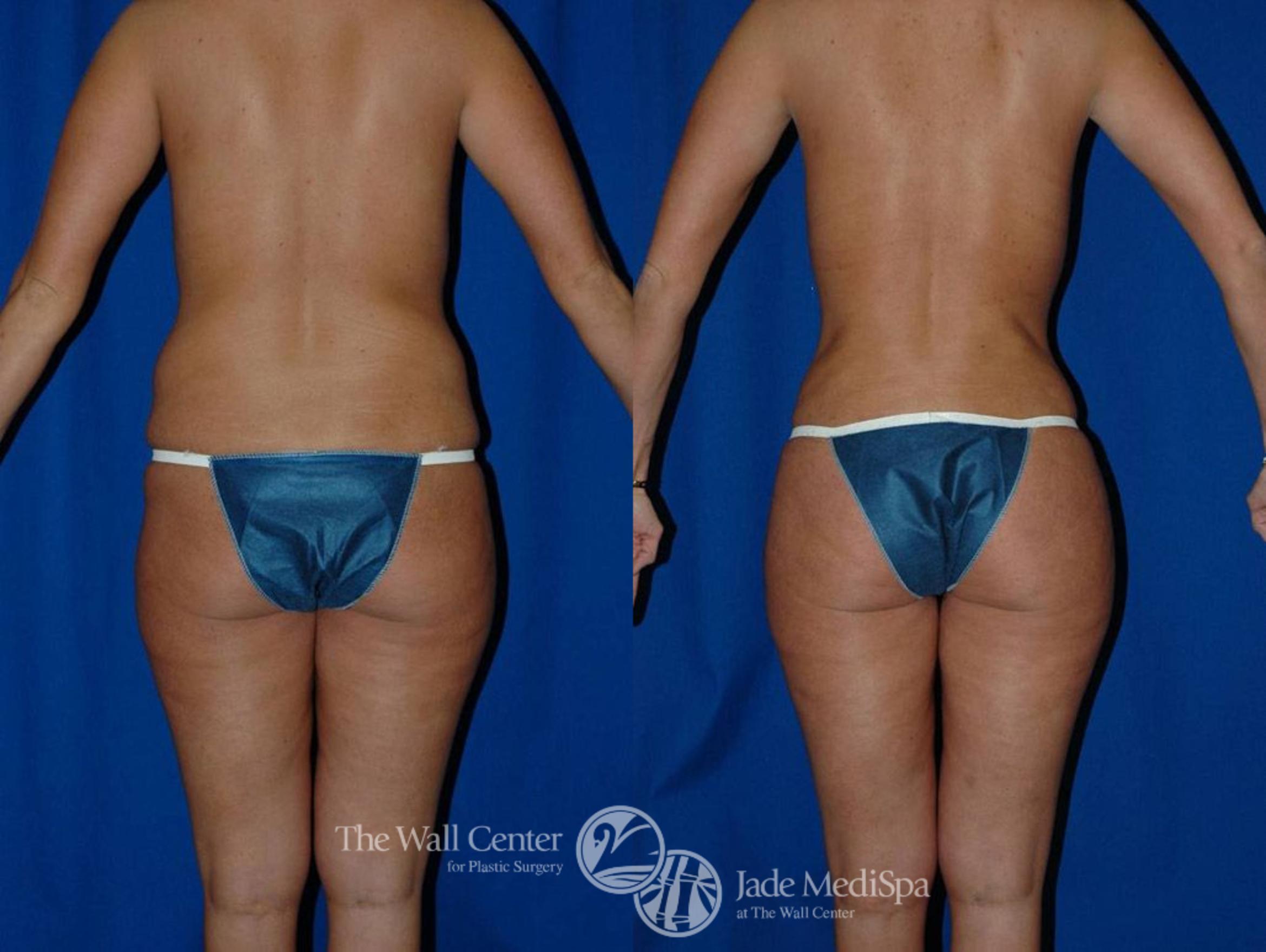 Before & After Tummy Tuck Case 23 View #4 View in Shreveport, LA