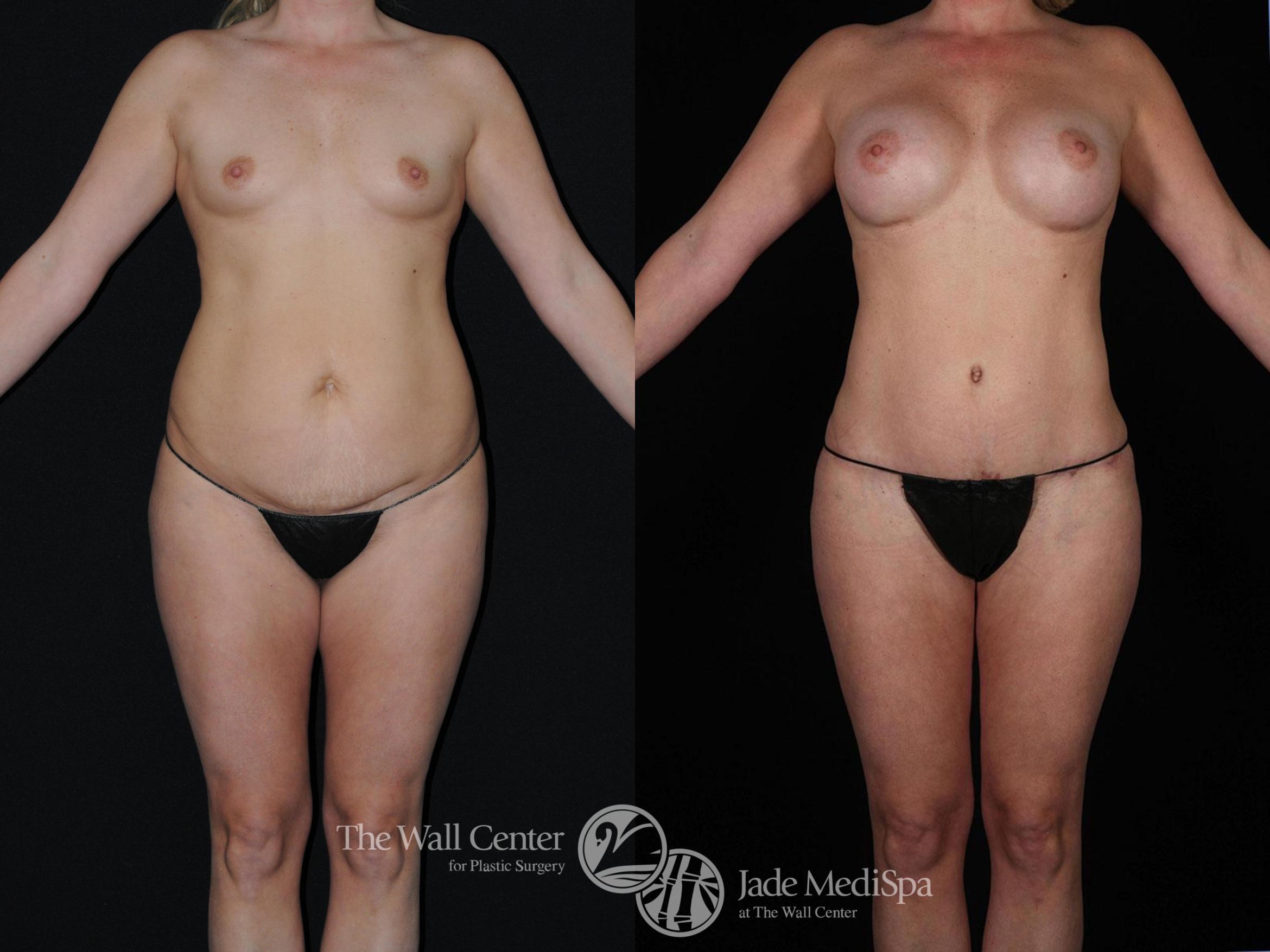 Before & After Tummy Tuck Case 249 View #1 View in Shreveport, LA