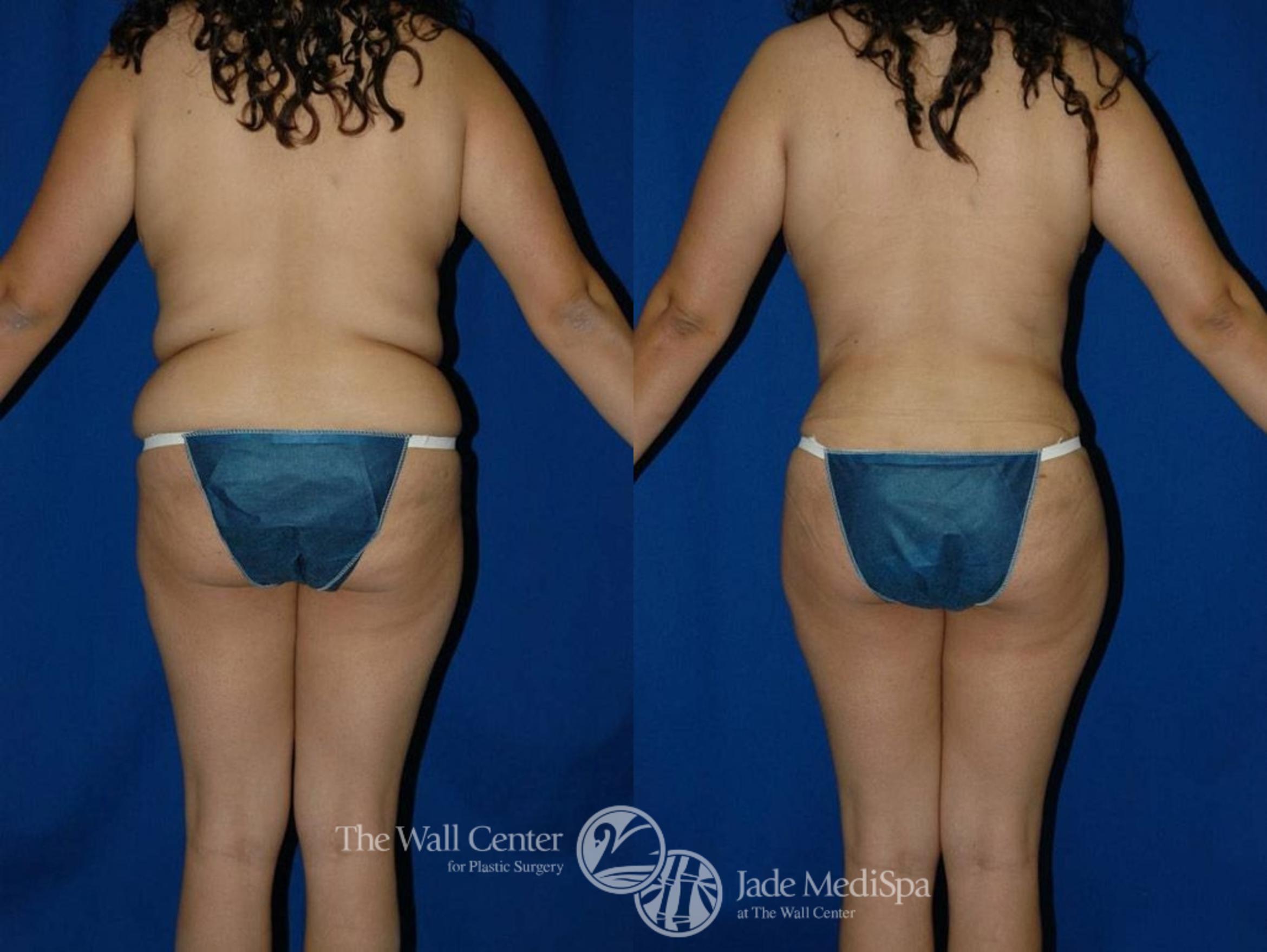 Abdominoplasty with SAFELipo Front Photo, Shreveport, LA, The Wall Center for Plastic Surgery, Case 25