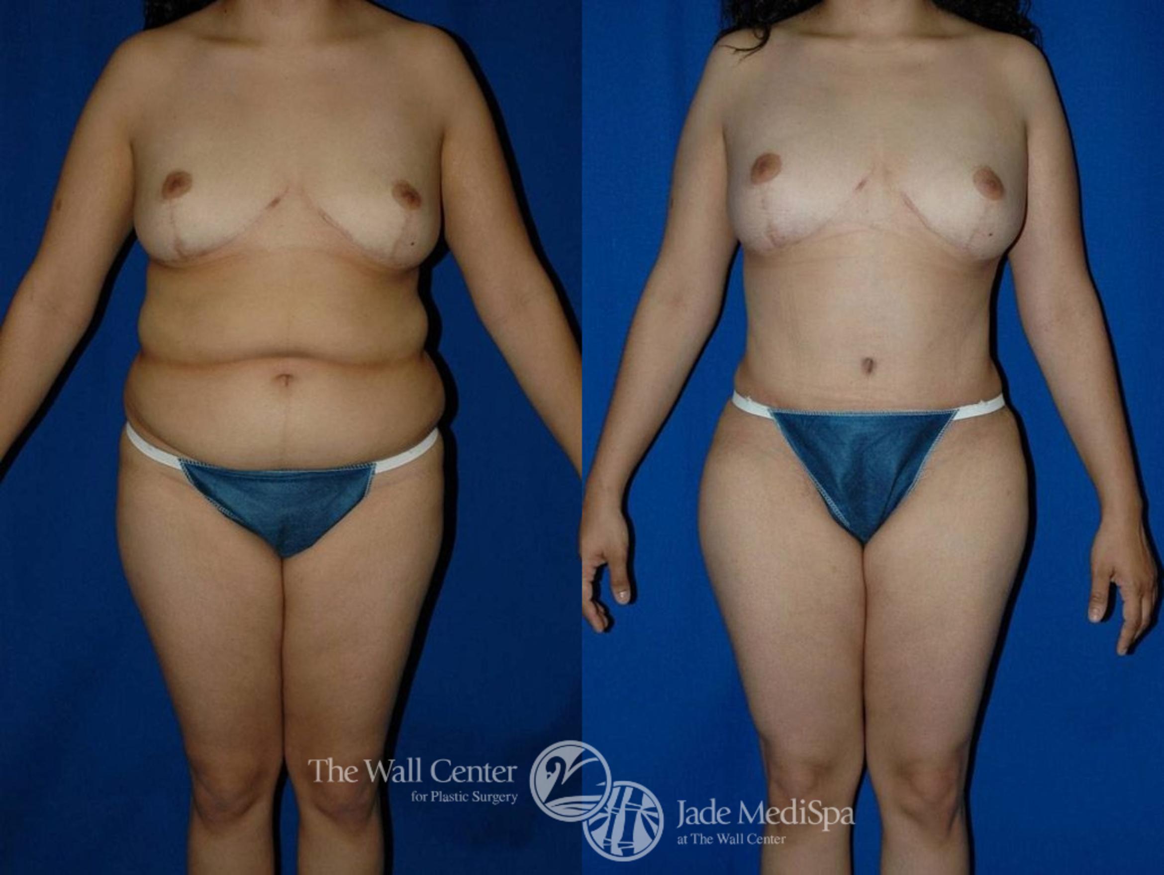 Abdominoplasty with SAFELipo Front Photo, Shreveport, LA, The Wall Center for Plastic Surgery, Case 25