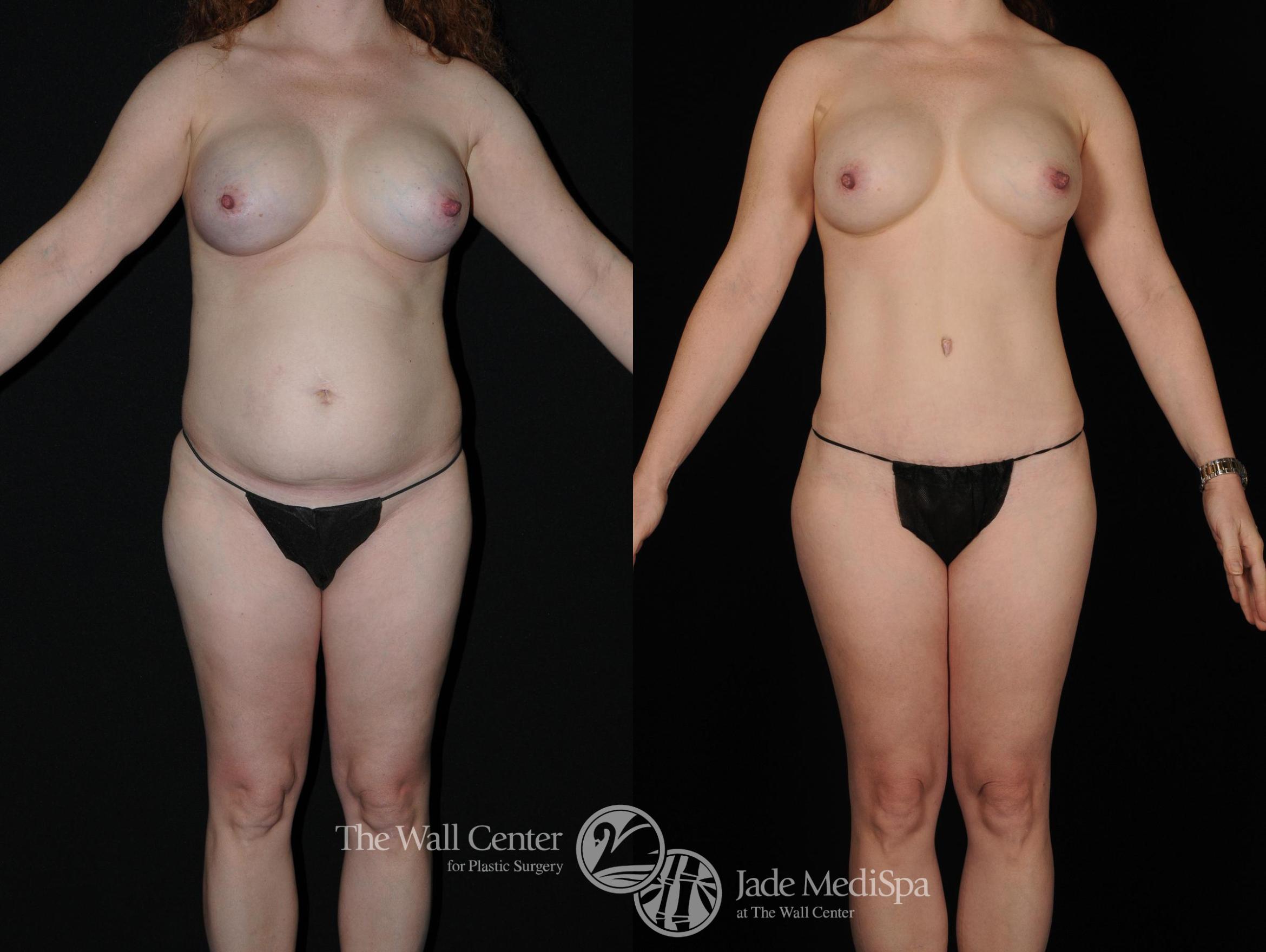 Before & After Tummy Tuck Case 381 View #1 View in Shreveport, LA