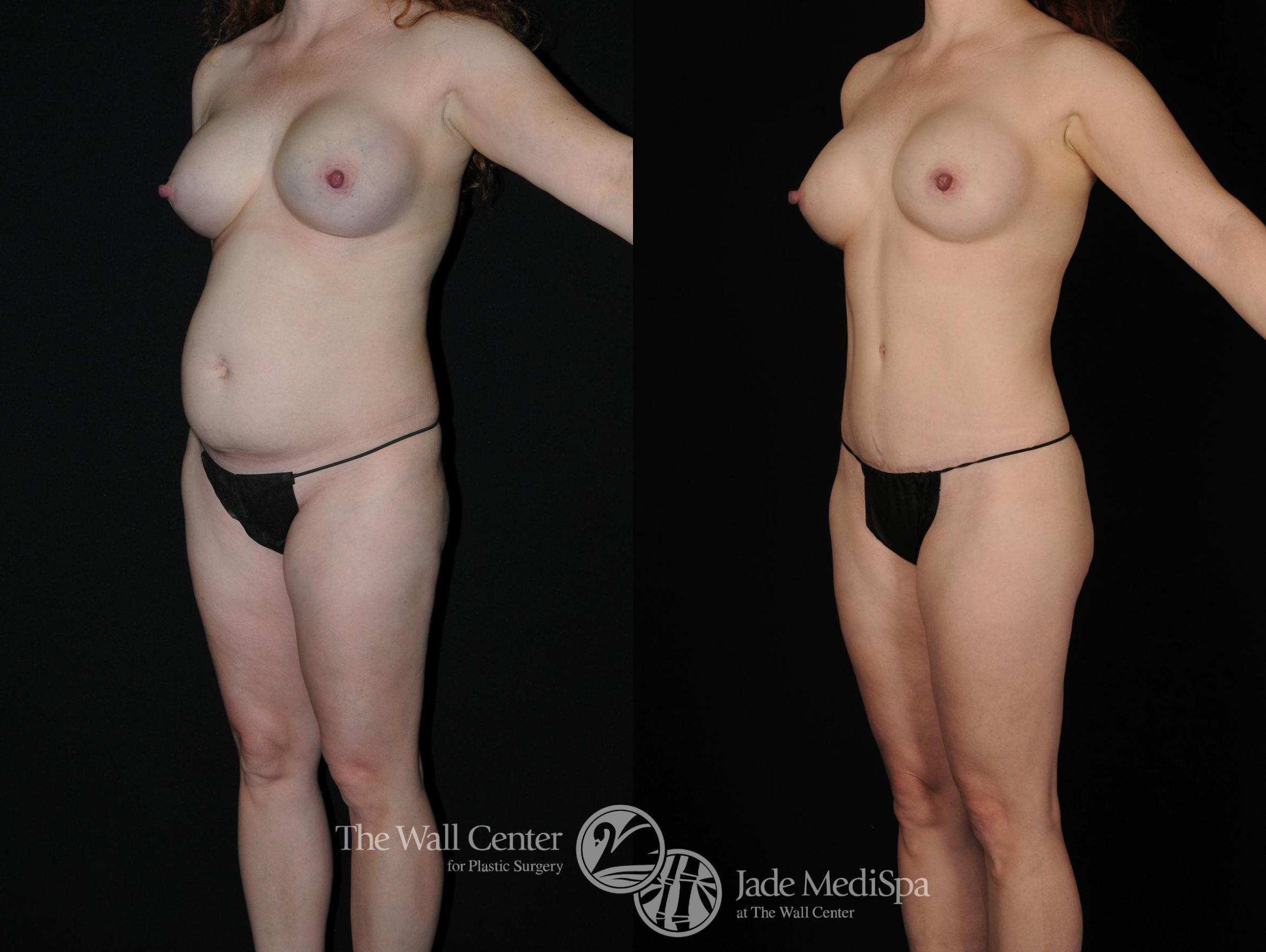 Before & After Tummy Tuck Case 381 View #2 View in Shreveport, LA