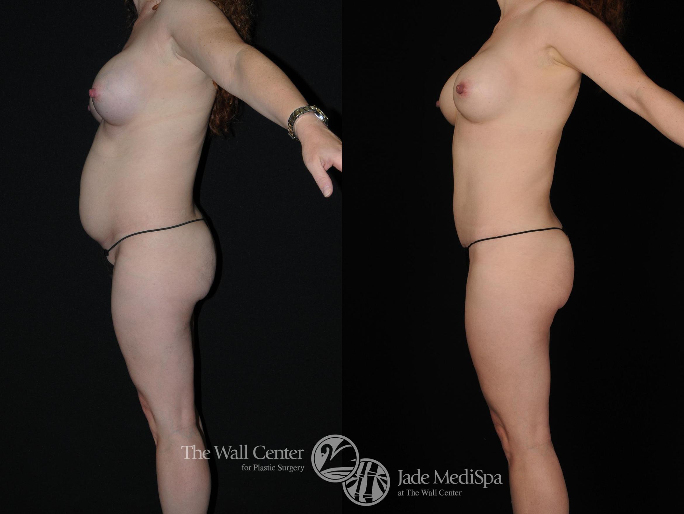Before & After Tummy Tuck Case 381 View #3 View in Shreveport, LA