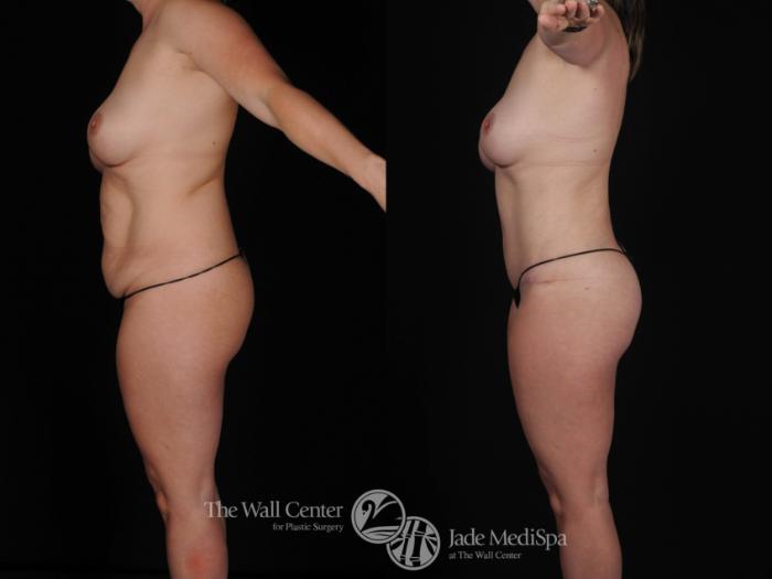 Before & After Tummy Tuck Case 447 View #1 View in Shreveport, LA