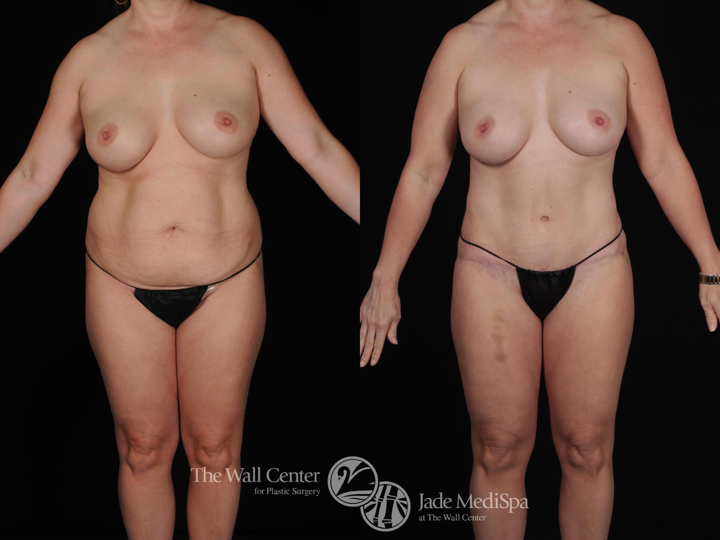 Before & After Tummy Tuck Case 447 View #2 View in Shreveport, LA