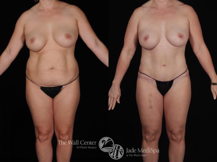 Before & After Tummy Tuck Case 447 View #2 View in Shreveport, LA