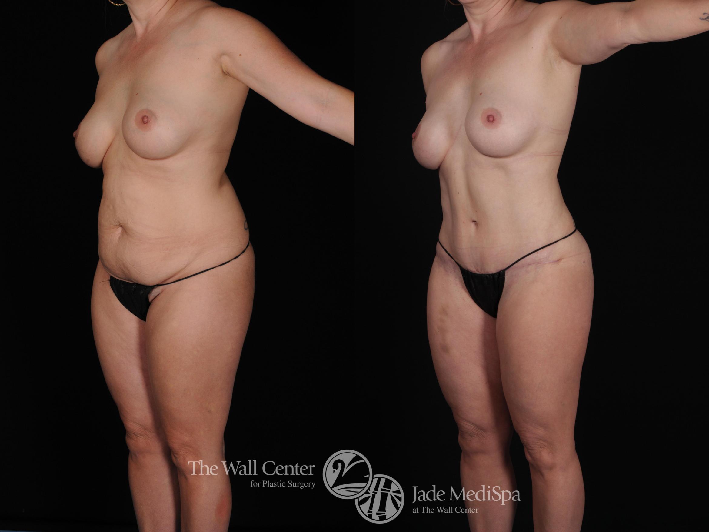 Before & After Tummy Tuck Case 447 View #3 View in Shreveport, LA
