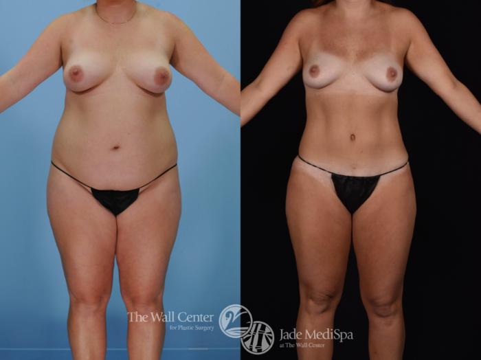 Before & After Tummy Tuck Case 477 View #1 View in Shreveport, LA