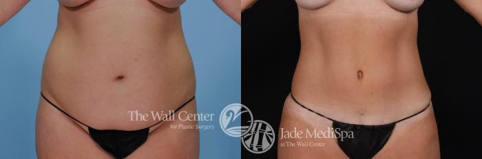 Before & After Tummy Tuck Case 477 View #2 View in Shreveport, LA