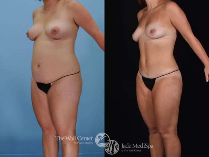 Before & After Tummy Tuck Case 477 View #3 View in Shreveport, LA