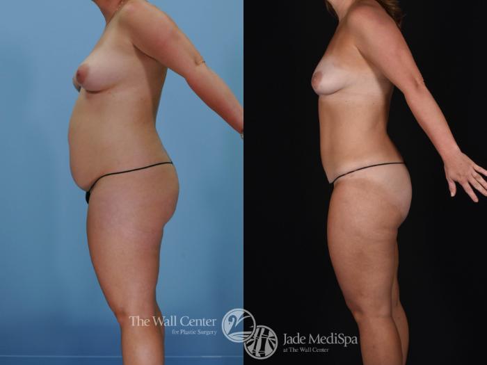 Before & After Tummy Tuck Case 477 View #4 View in Shreveport, LA