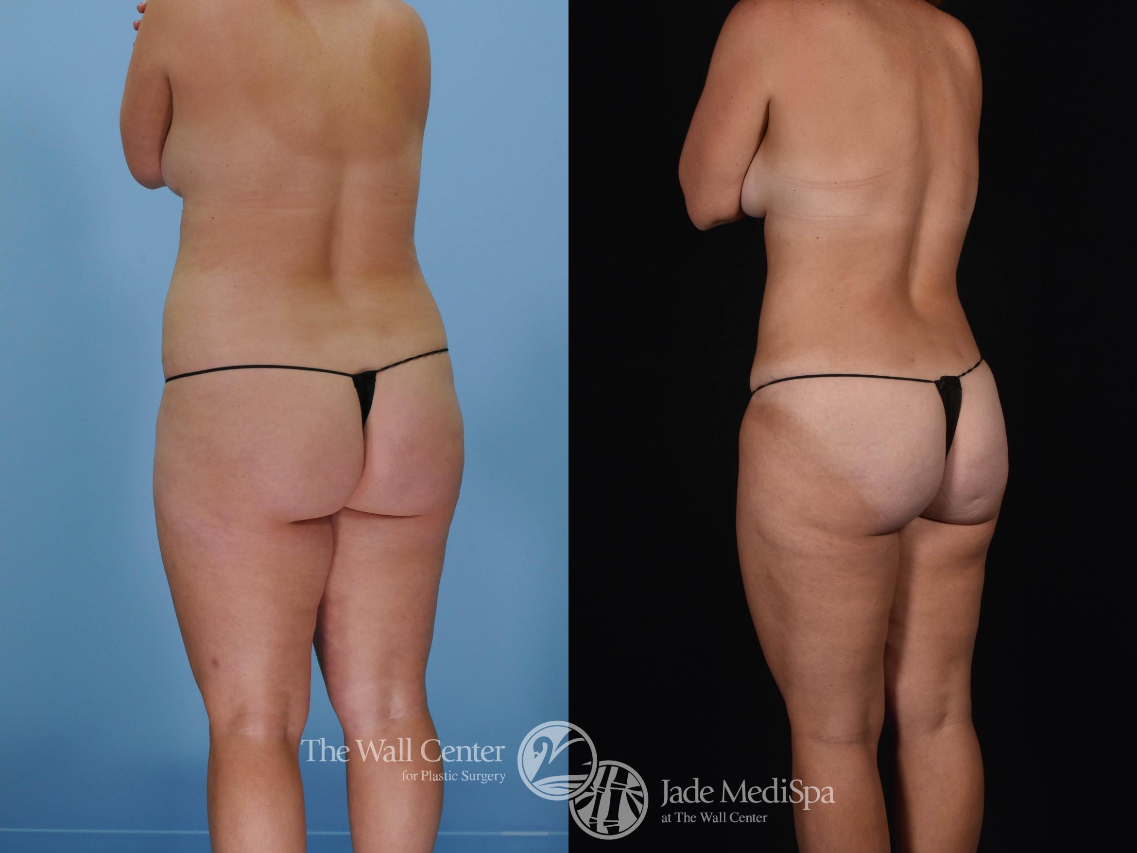 Before & After Tummy Tuck Case 477 View #5 View in Shreveport, LA