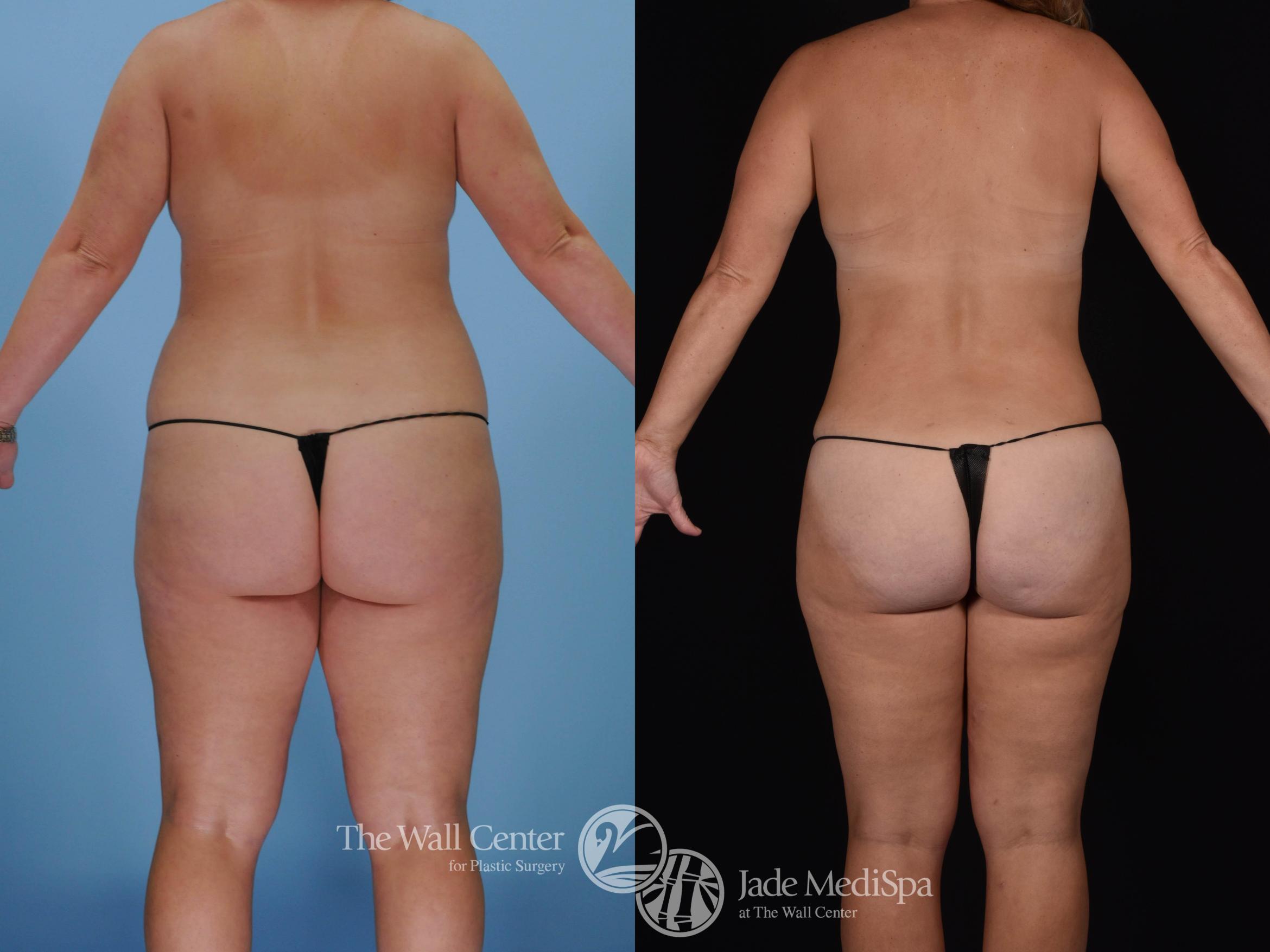 Before & After Tummy Tuck Case 477 View #6 View in Shreveport, LA