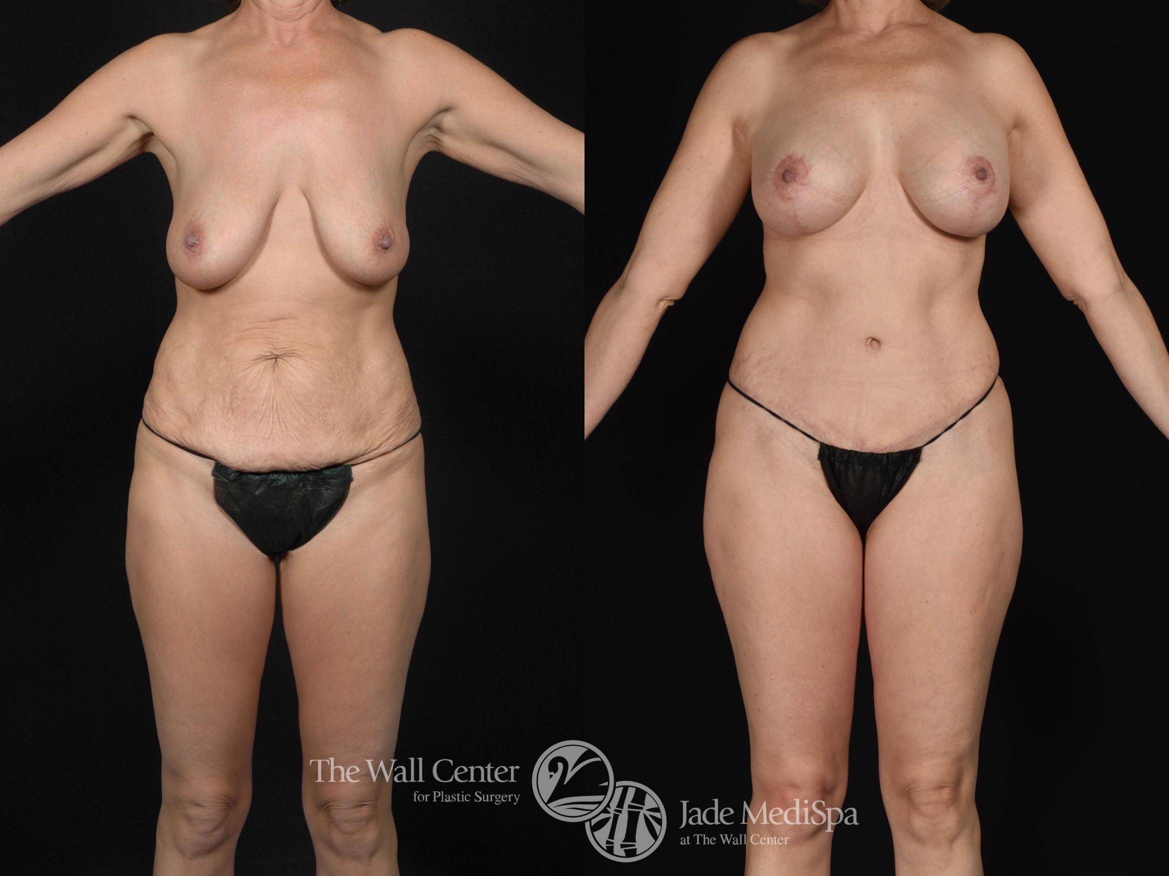 Before & After Tummy Tuck Case 478 View #1 View in Shreveport, LA