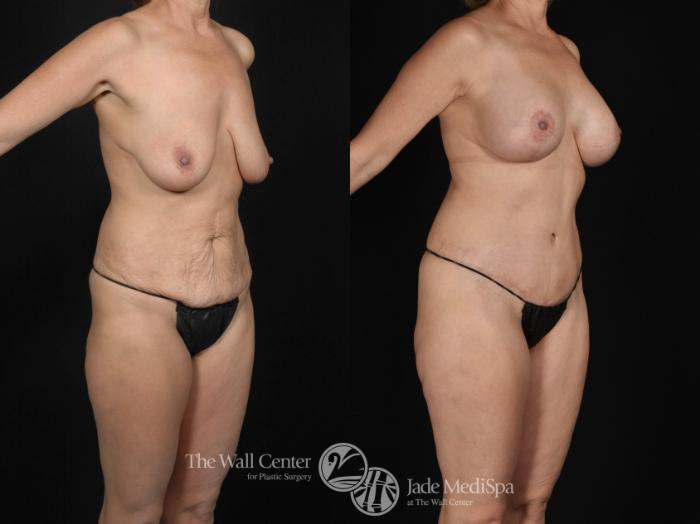 Before & After After Massive Weight Loss Case 478 View #2 View in Shreveport, LA