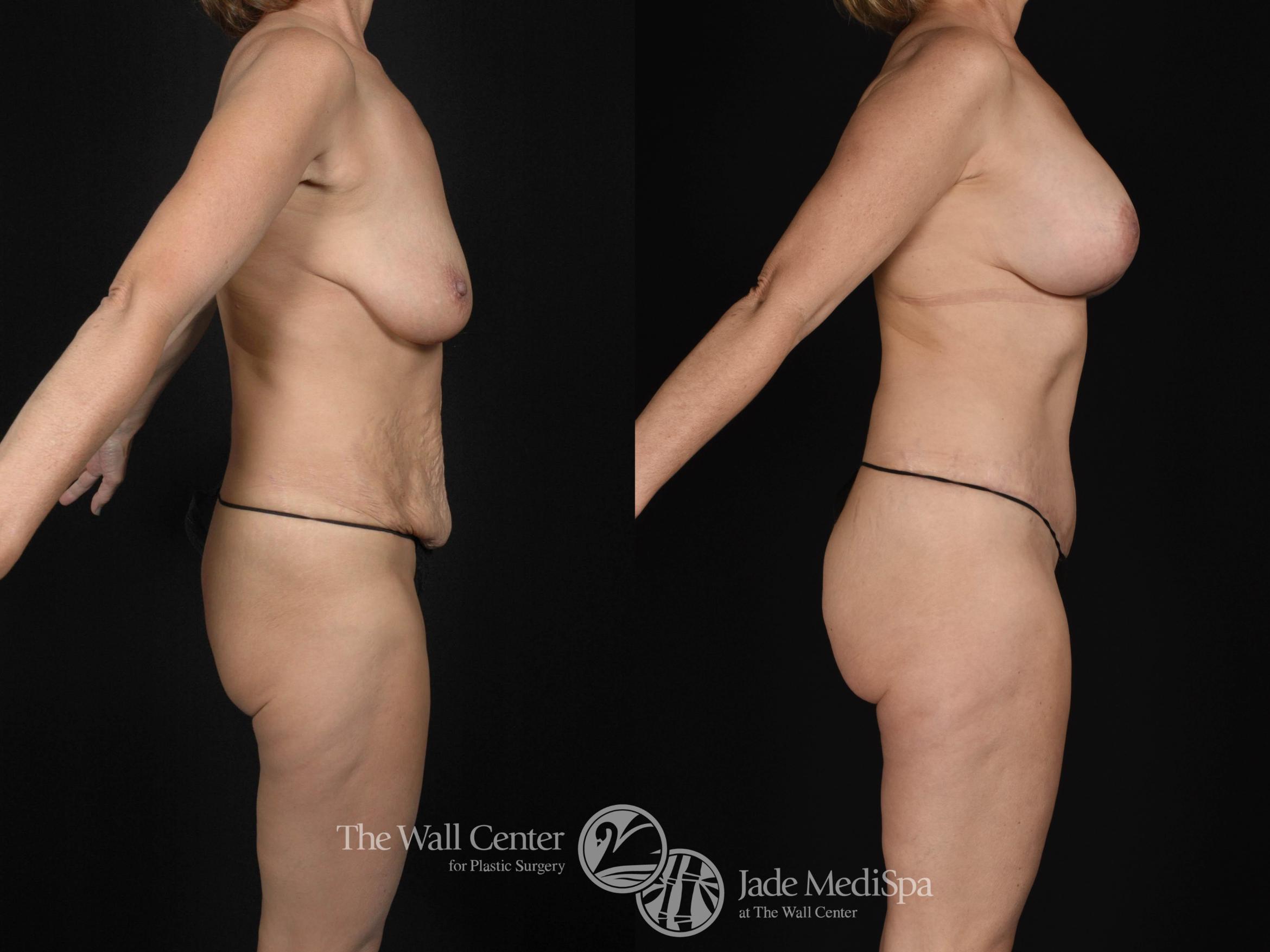 Before & After Tummy Tuck Case 478 View #3 View in Shreveport, LA