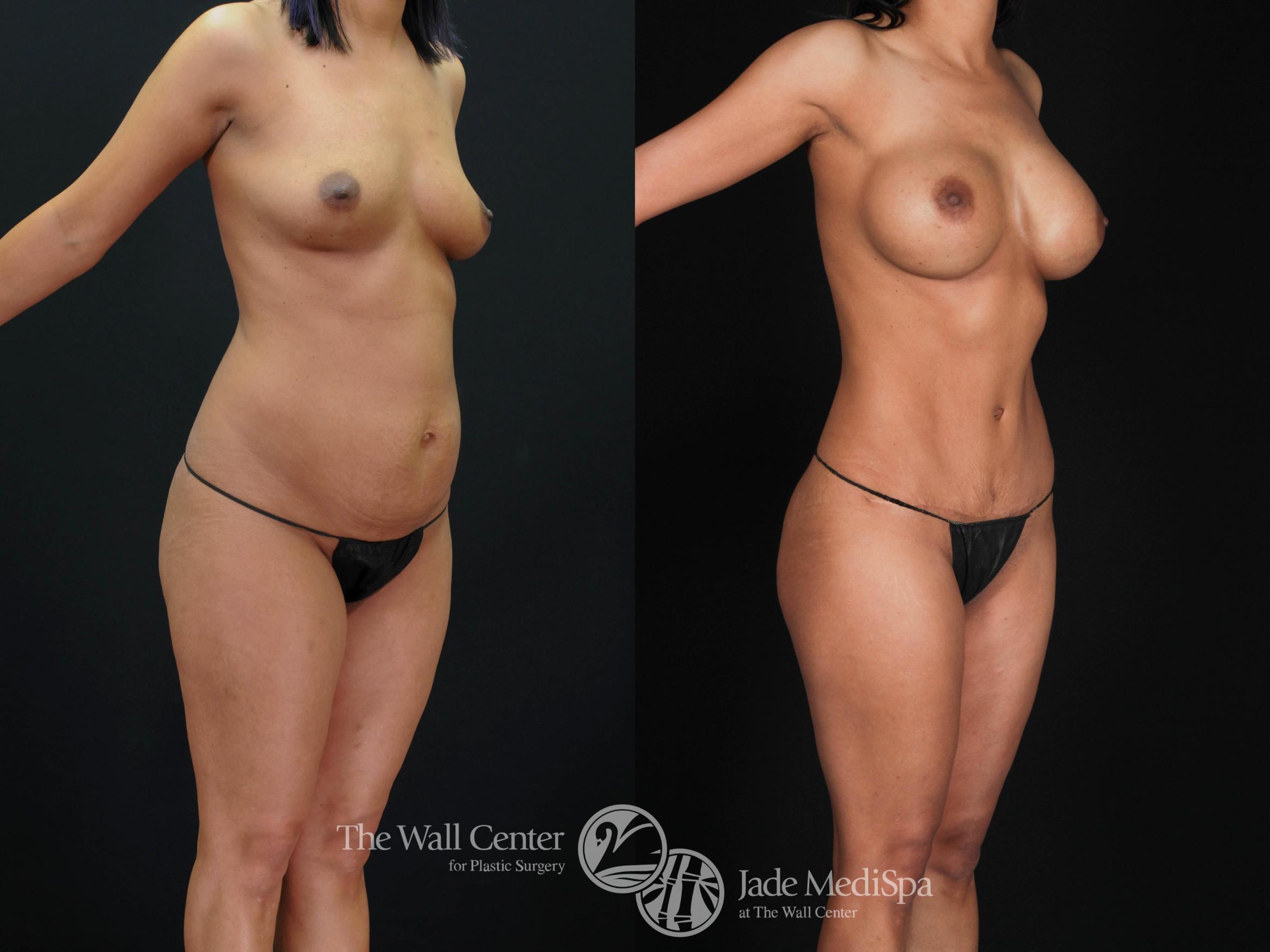 Before & After Tummy Tuck Case 479 View #1 View in Shreveport, LA