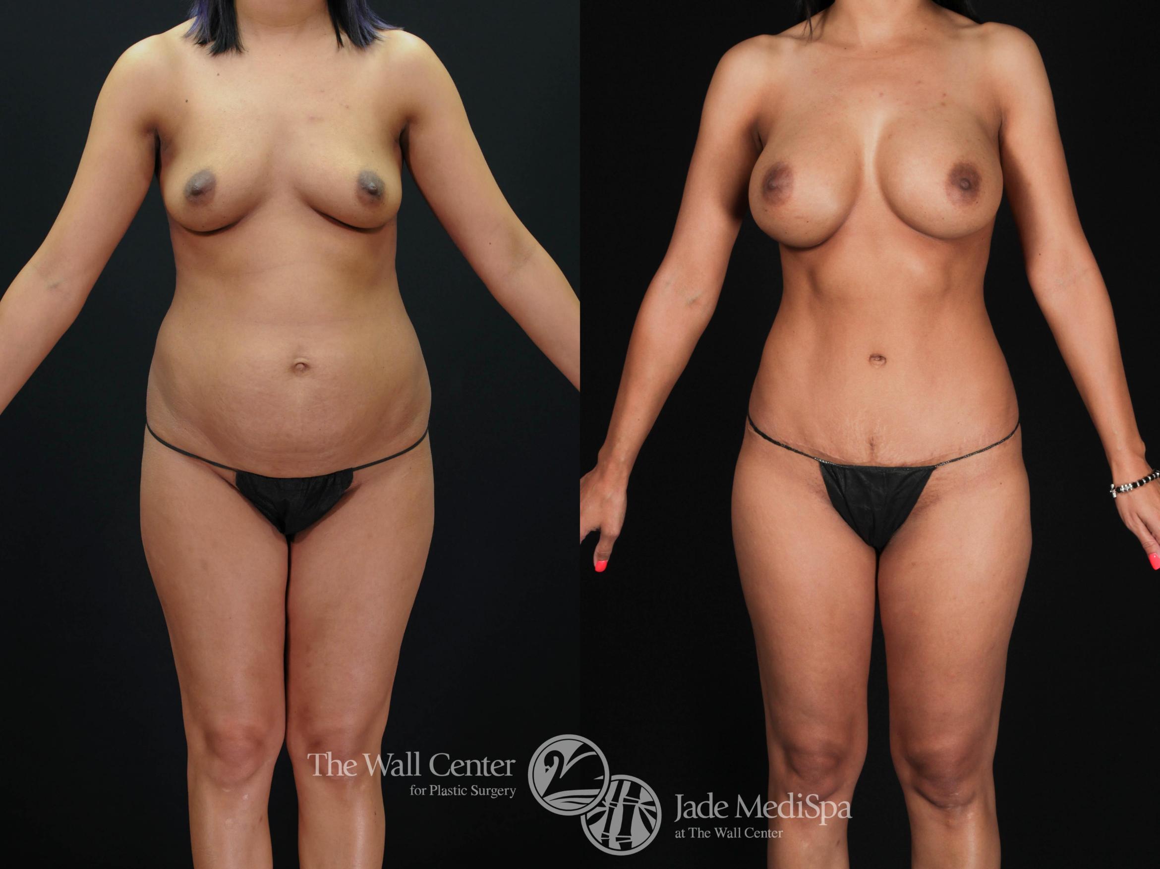 Before & After Tummy Tuck Case 479 View #2 View in Shreveport, LA