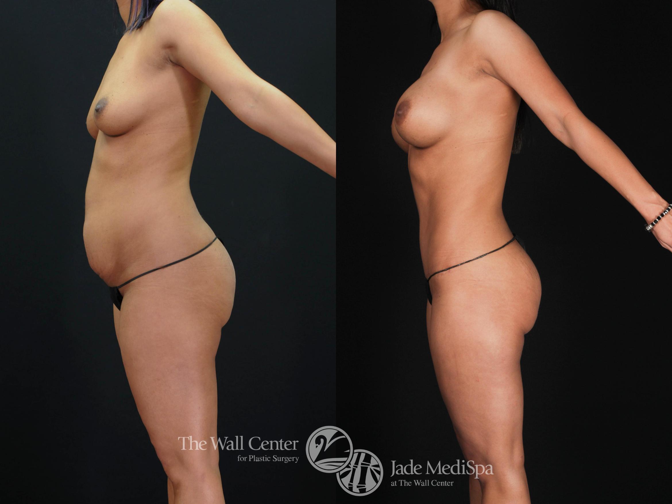 Before & After Tummy Tuck Case 479 View #3 View in Shreveport, LA
