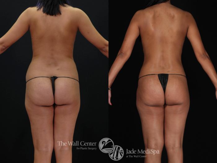 Before & After Tummy Tuck Case 479 View #4 View in Shreveport, LA