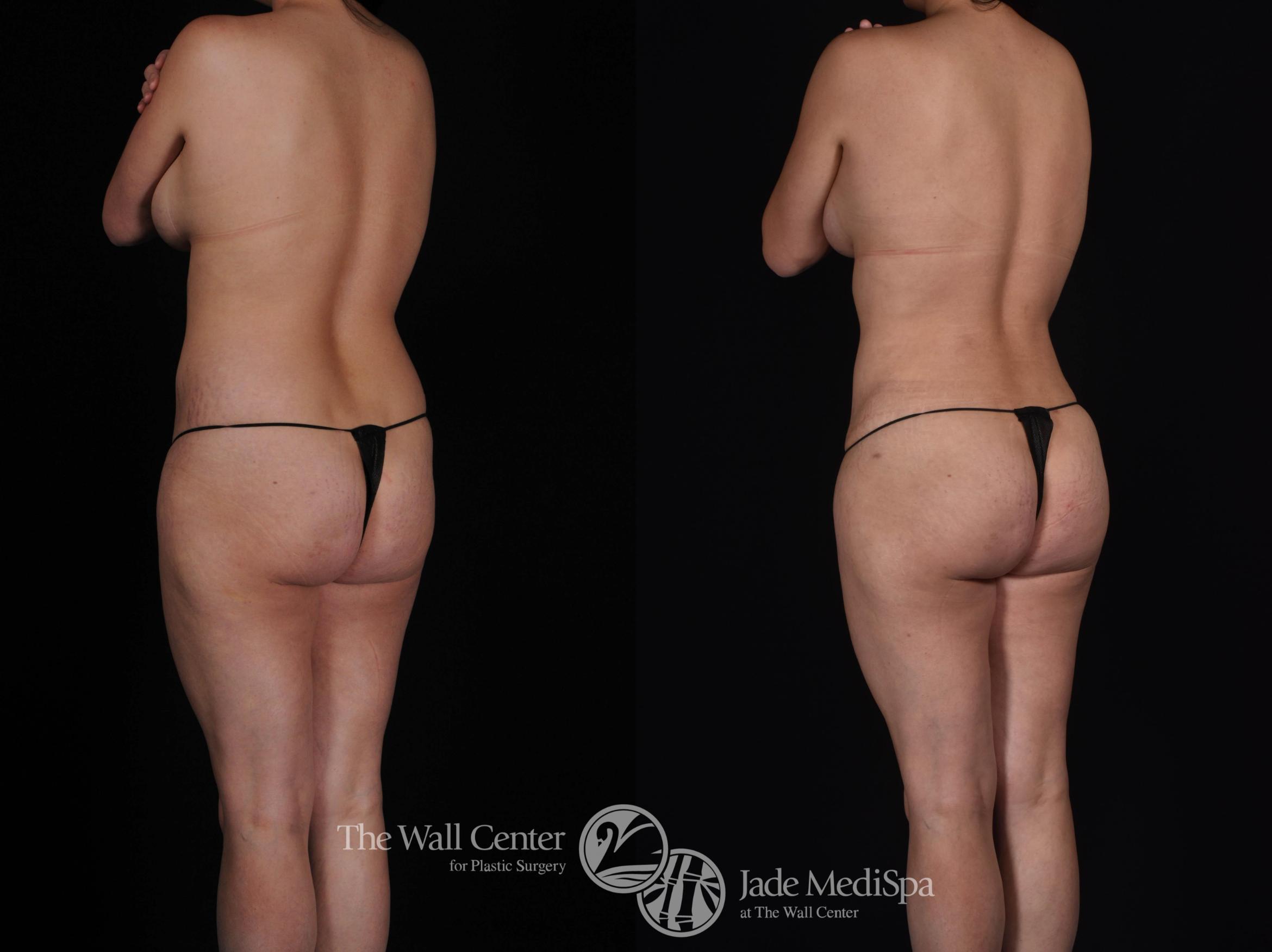 Before & After Tummy Tuck Case 496 View #1 View in Shreveport, LA