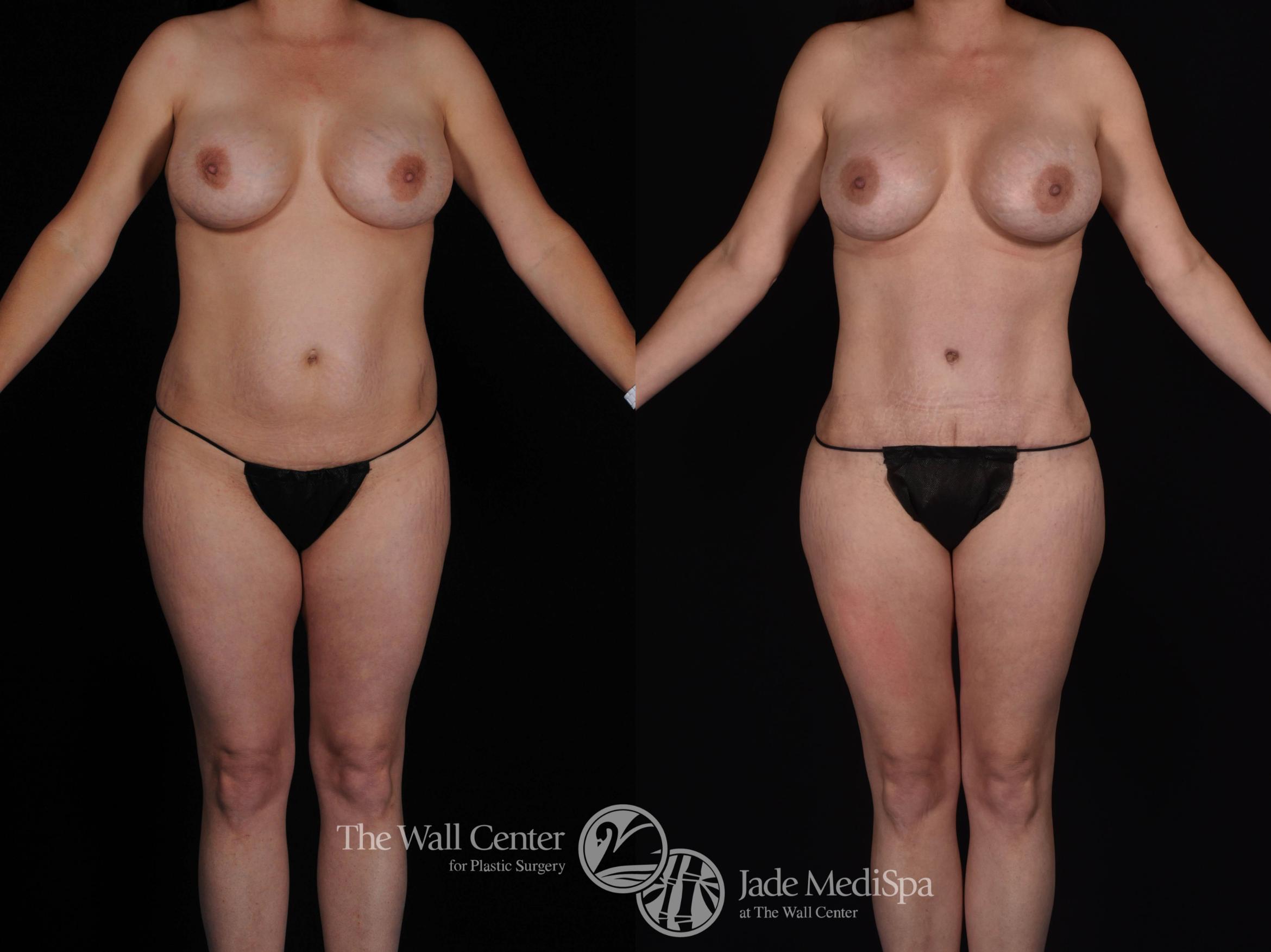 Before & After Tummy Tuck Case 496 View #2 View in Shreveport, LA