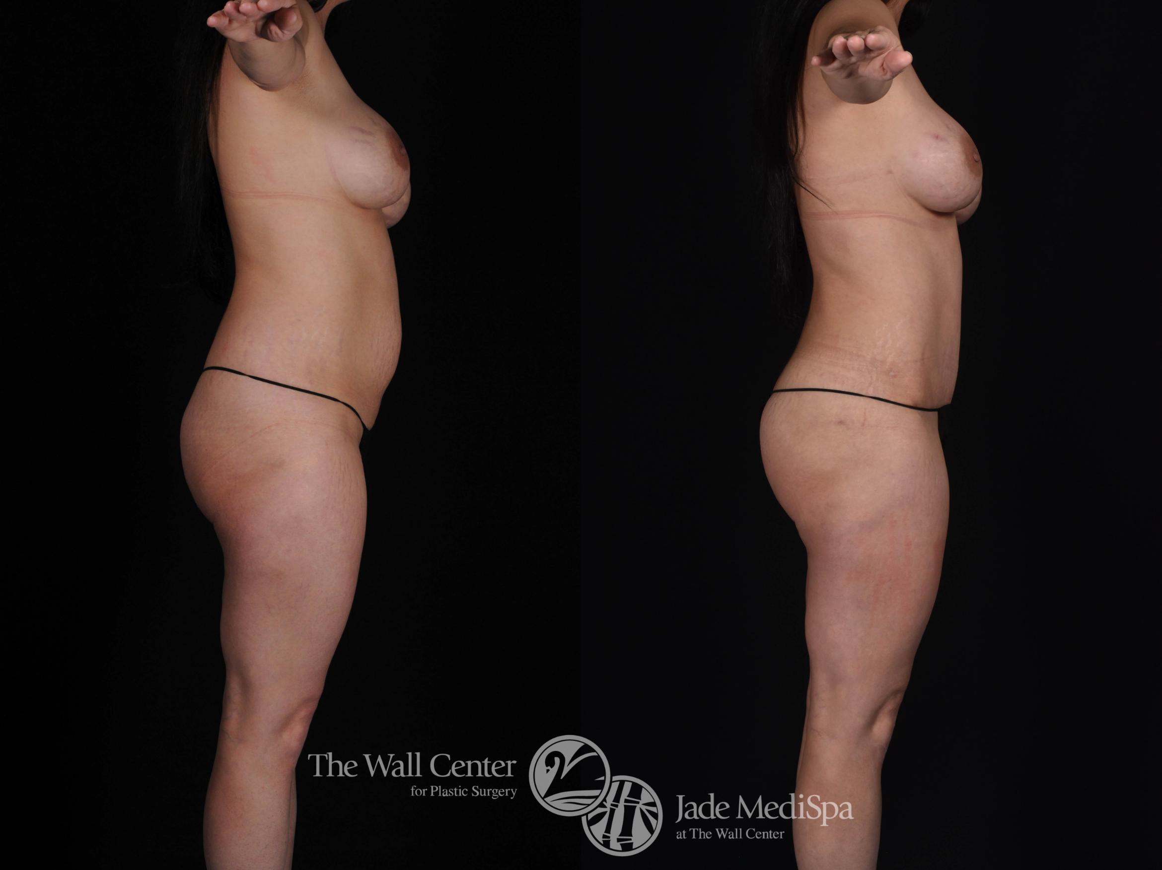 Before & After Tummy Tuck Case 496 View #4 View in Shreveport, LA