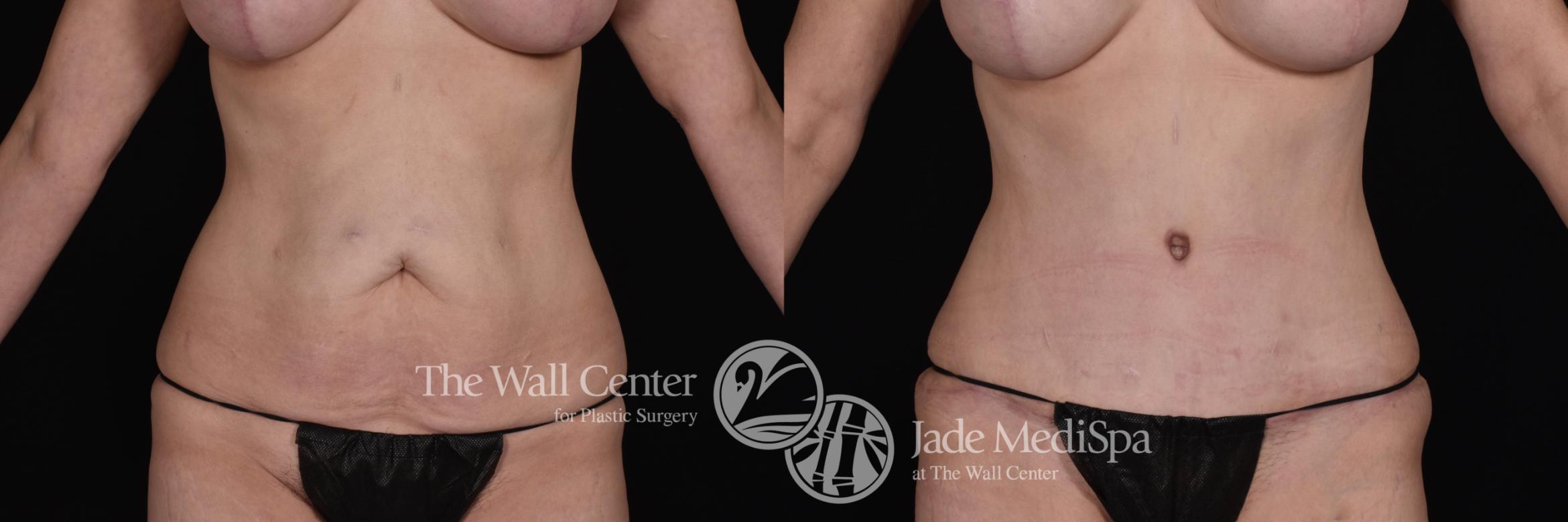 Before & After Tummy Tuck Case 504 View #1 View in Shreveport, LA