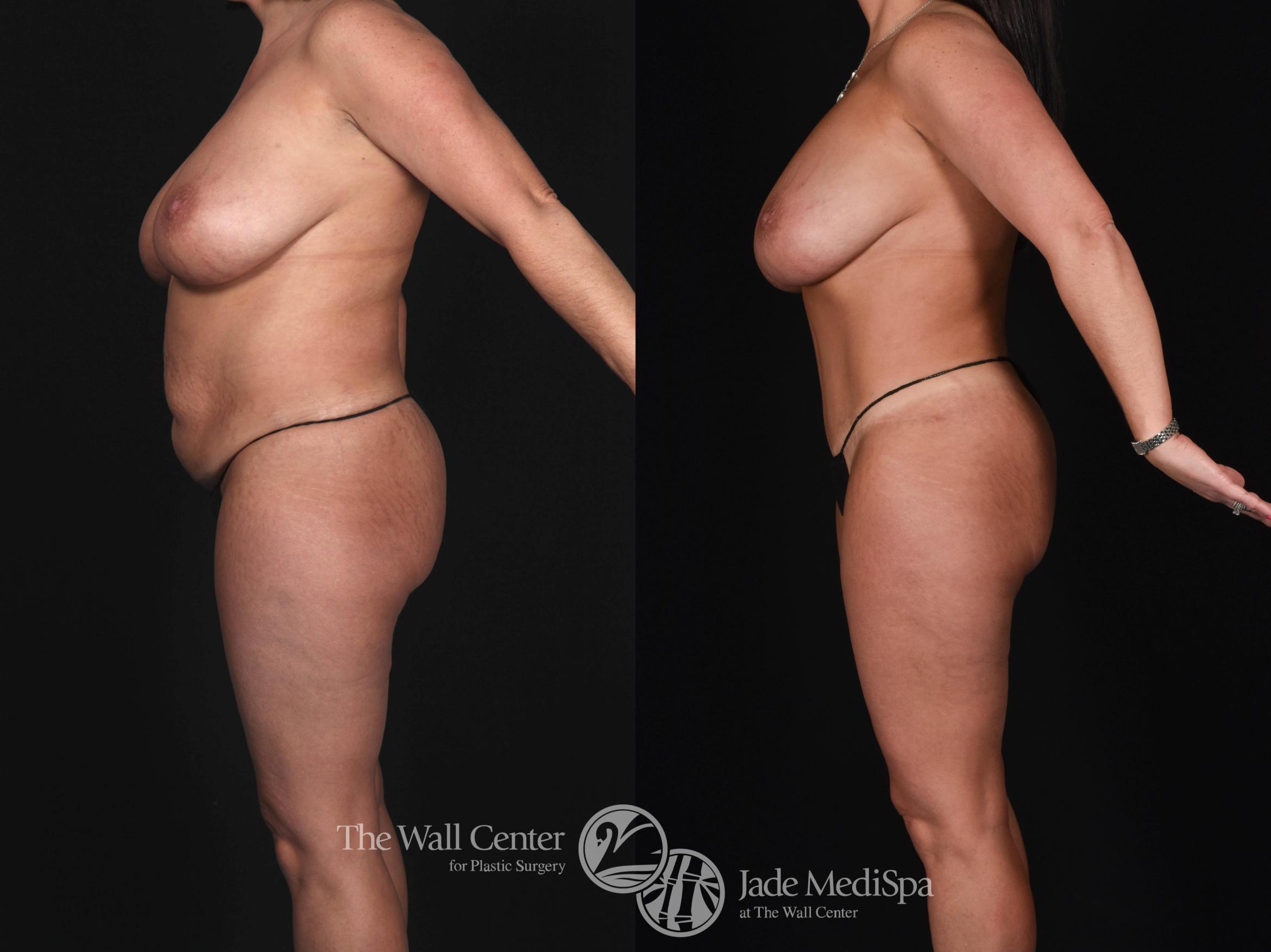 Before & After Tummy Tuck Case 562 View #1 View in Shreveport, LA