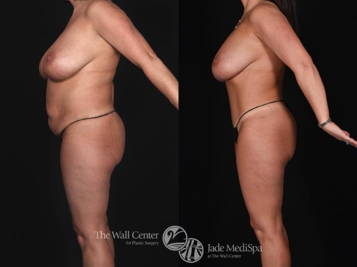Before & After Tummy Tuck Case 562 View #1 View in Shreveport, LA