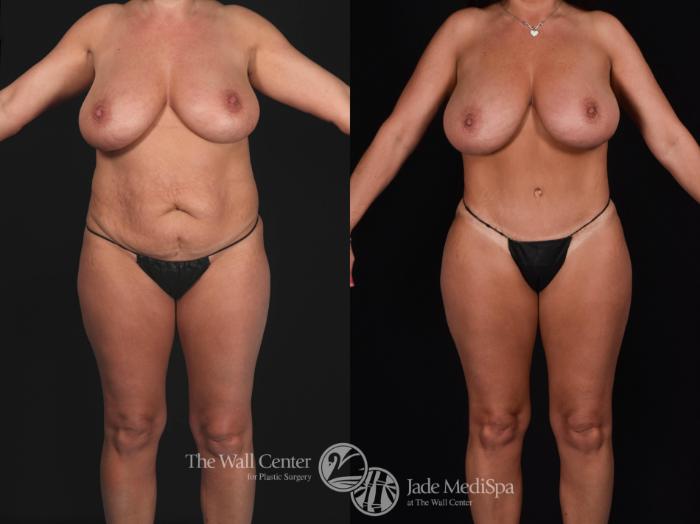 Before & After Tummy Tuck Case 562 View #2 View in Shreveport, LA
