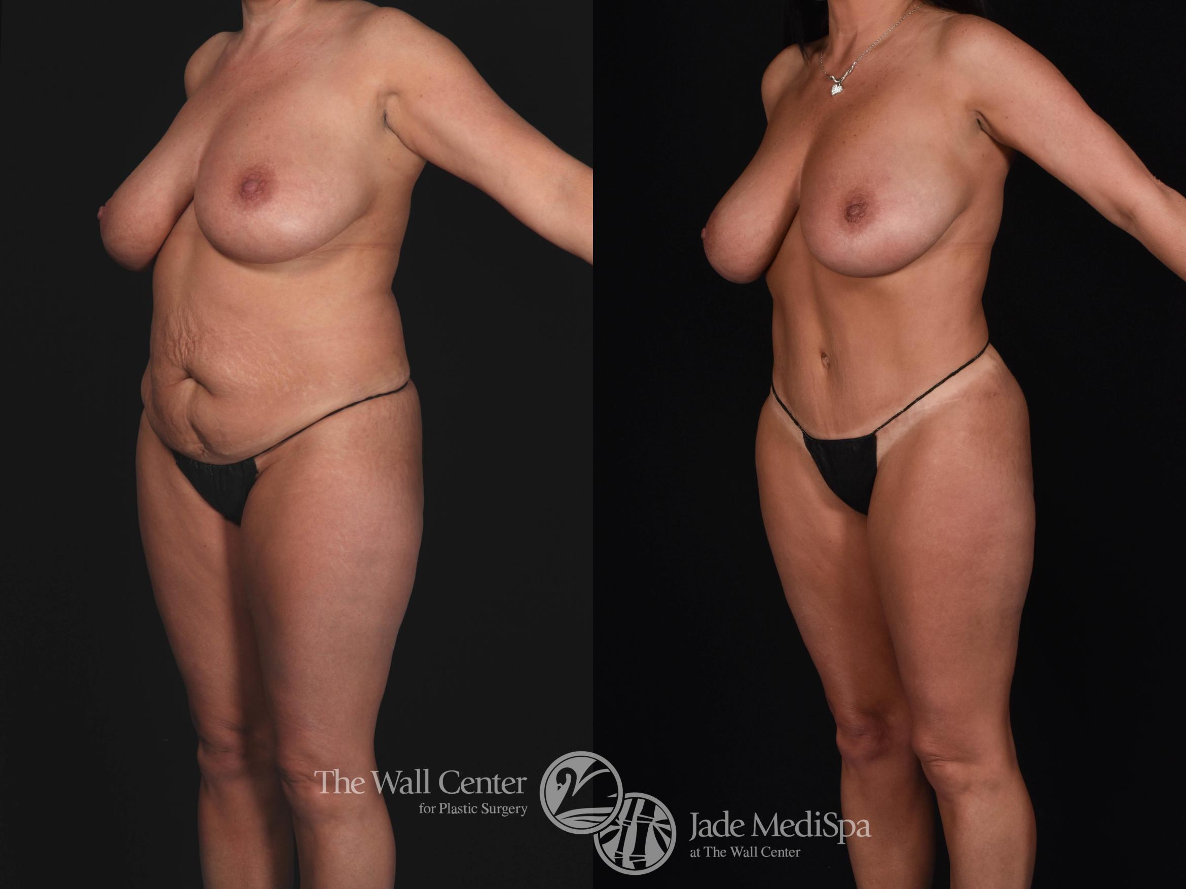 Before & After Tummy Tuck Case 562 View #3 View in Shreveport, LA