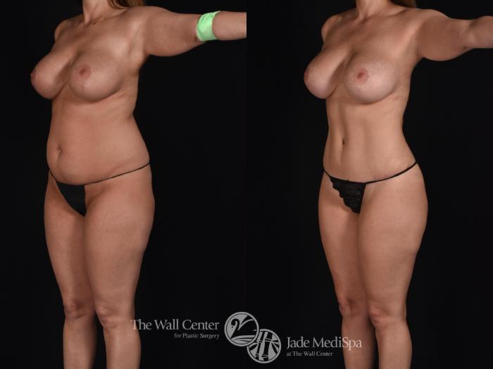 Before & After Tummy Tuck Case 570 View #2 View in Shreveport, LA
