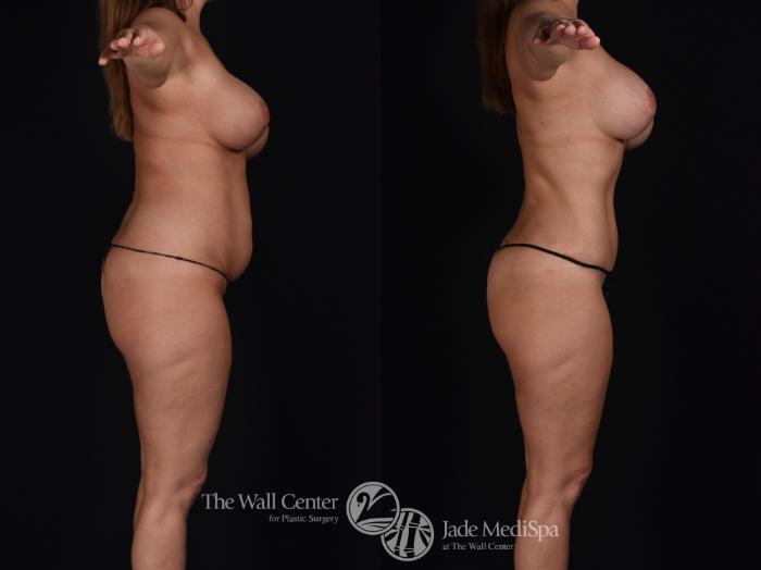 Before & After Tummy Tuck Case 570 View #3 View in Shreveport, LA