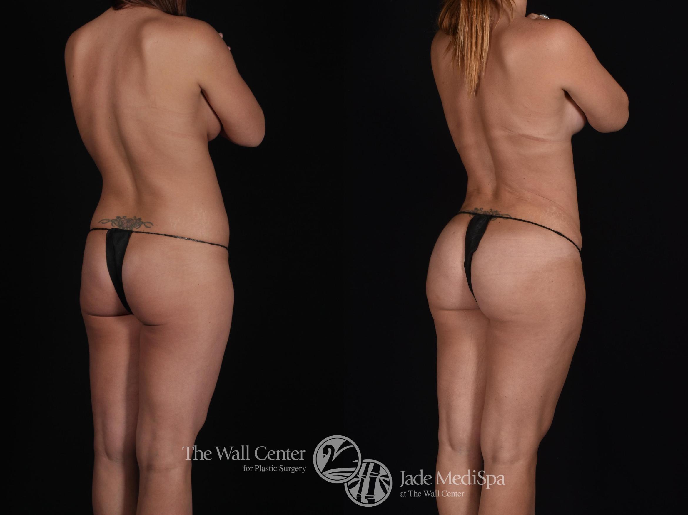 Before & After Tummy Tuck Case 573 View #1 View in Shreveport, LA