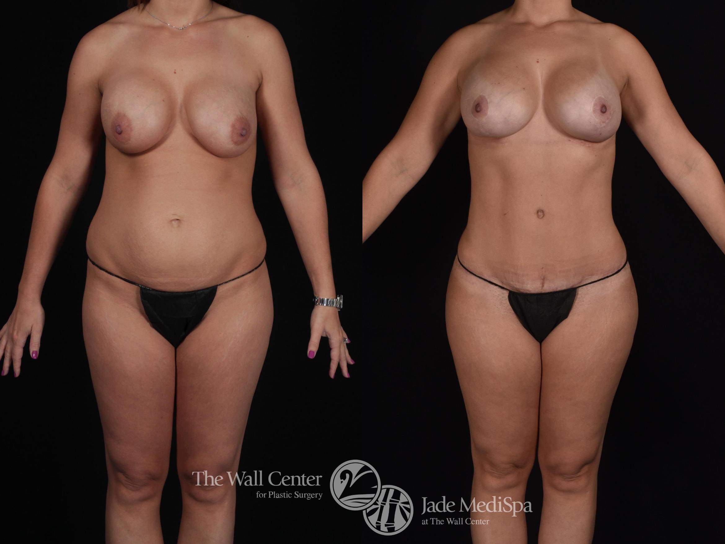 Before & After Tummy Tuck Case 573 View #2 View in Shreveport, LA
