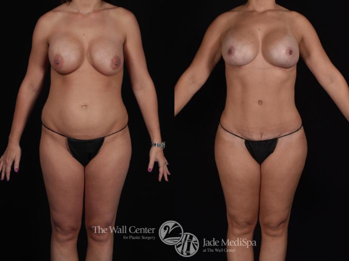Before & After Tummy Tuck Case 573 View #2 View in Shreveport, LA