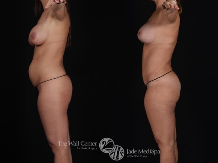 Before & After Fat Grafting – Buttocks Case 573 View #4 View in Shreveport, LA