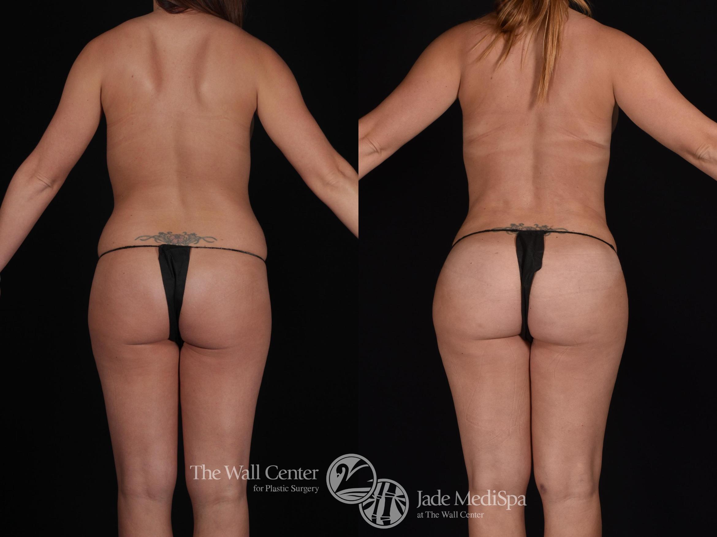 Before & After Tummy Tuck Case 573 View #5 View in Shreveport, LA