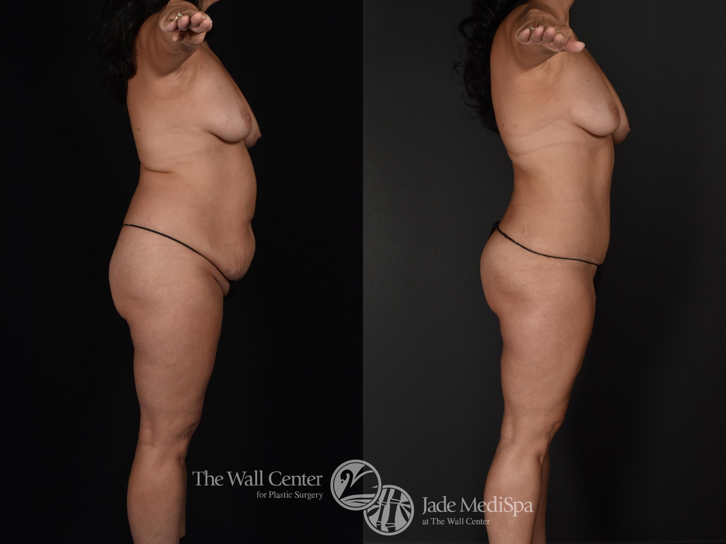 Before & After Tummy Tuck Case 589 View #1 View in Shreveport, LA