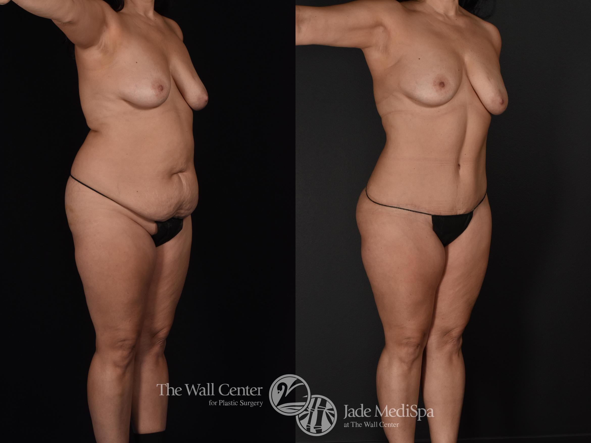 Before & After Tummy Tuck Case 589 View #2 View in Shreveport, LA