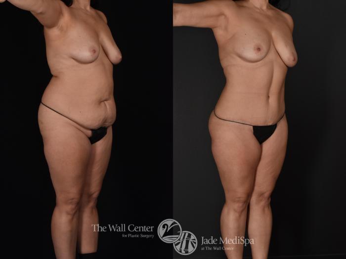 Before & After Tummy Tuck Case 589 View #2 View in Shreveport, LA