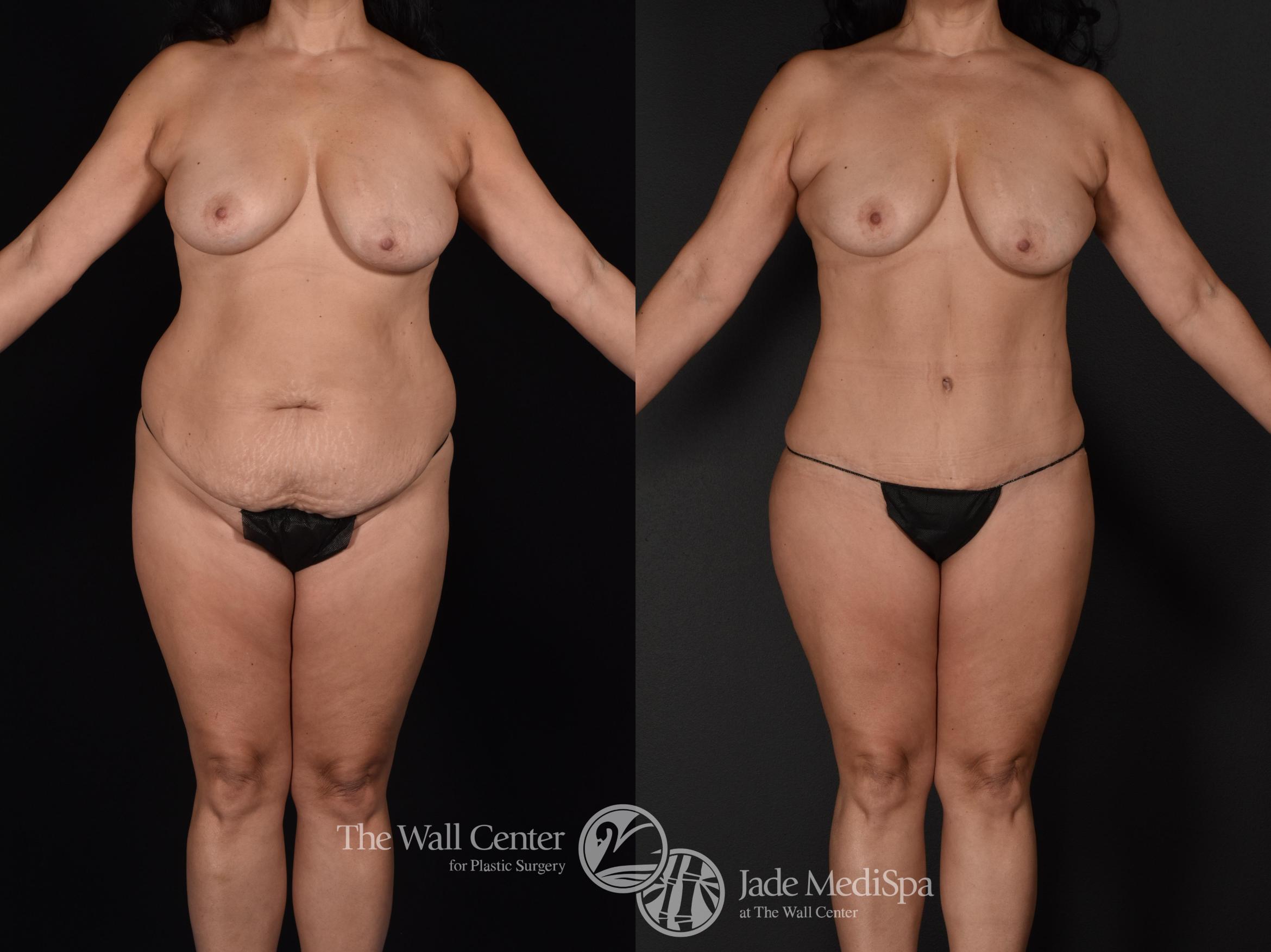 Before & After Tummy Tuck Case 589 View #3 View in Shreveport, LA