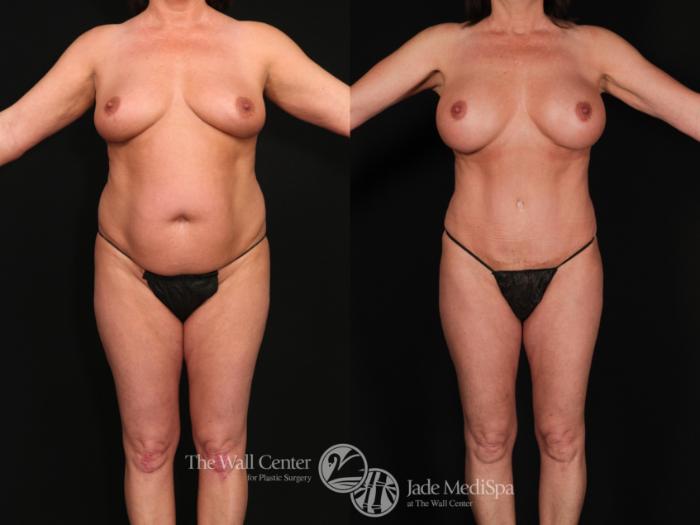 Before & After Tummy Tuck Case 618 View #1 View in Shreveport, LA