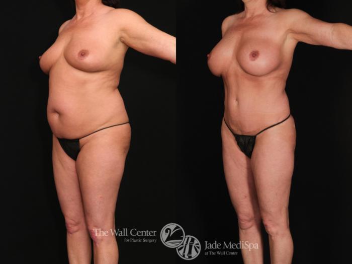 Before & After Tummy Tuck Case 618 View #2 View in Shreveport, LA